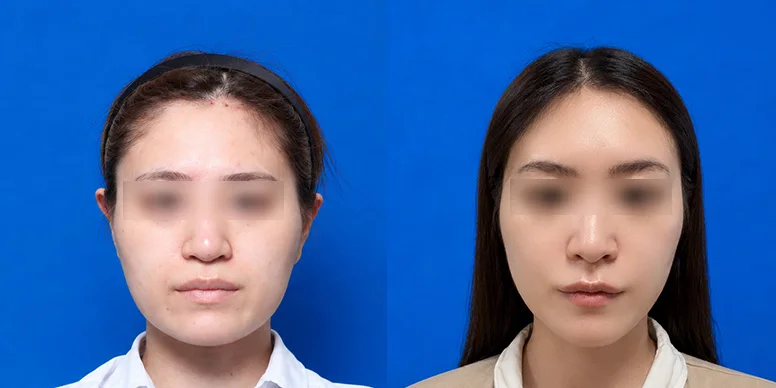 Facial Contouring Before & After — Before & After