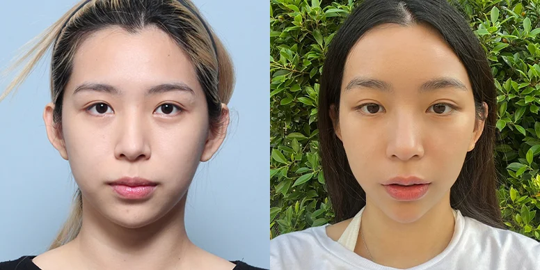 Lifting Before & After — Before & After