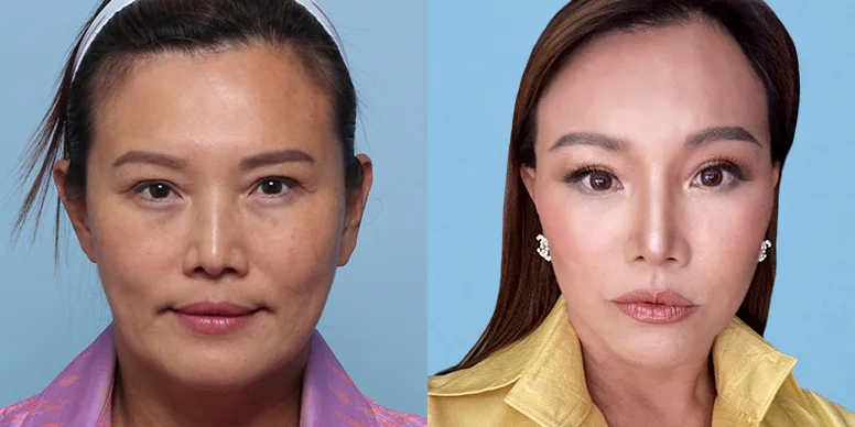Lifting Before & After — Before & After