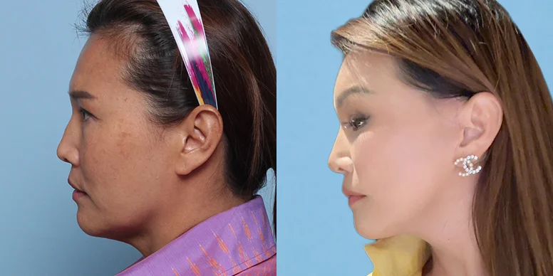 Before & After Before & After