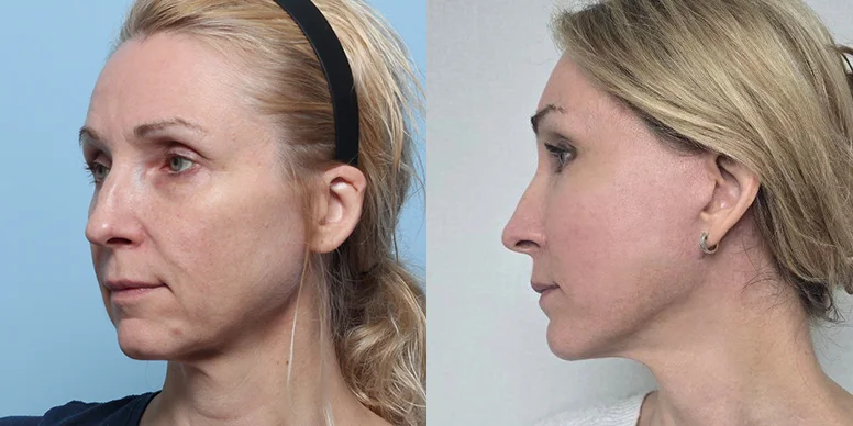 Before & After Before & After
