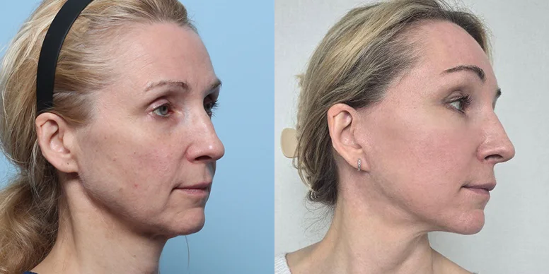 Before & After Before & After