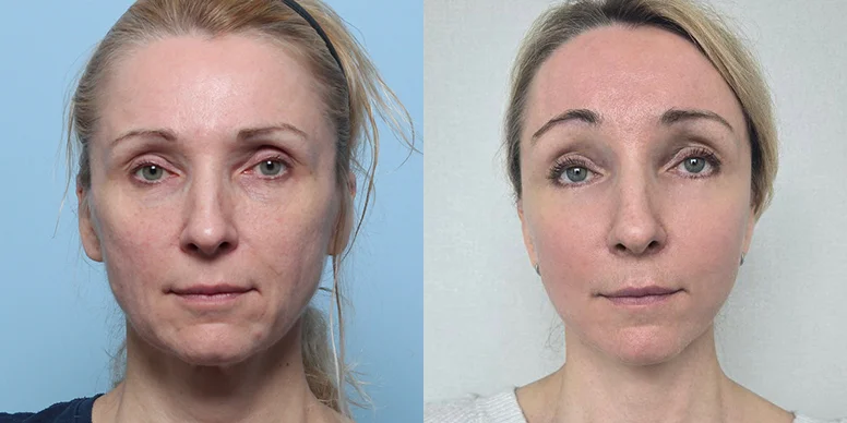 Lifting Before & After — Before & After