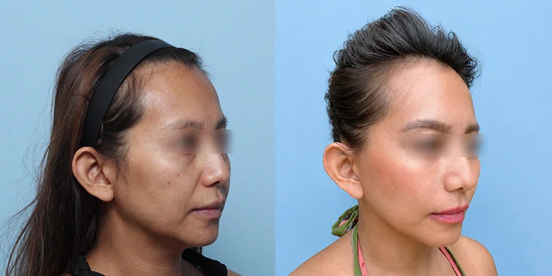 Before & After Before & After