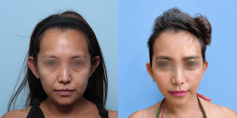 Lifting Before & After — Before & After