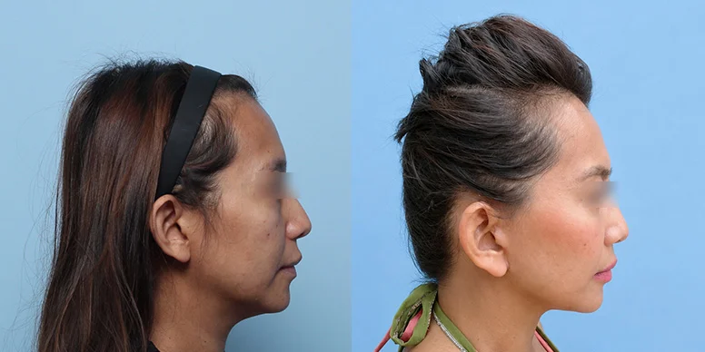 Before & After Before & After