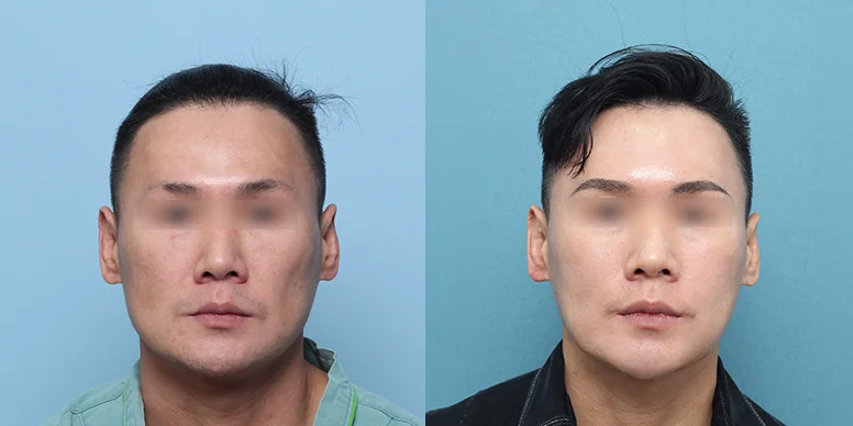 Liposuction Before & After — Before & After