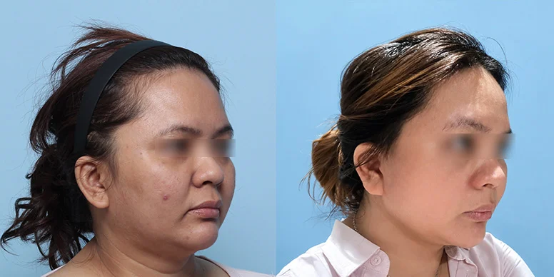 Before & After Before & After