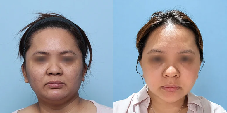 Lifting Before & After — Before & After