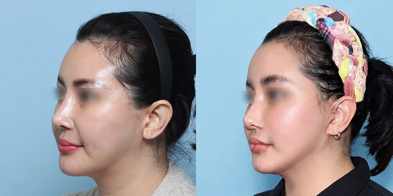 Lifting Before & After — Before & After