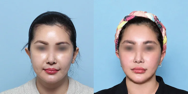 Before & After Before & After