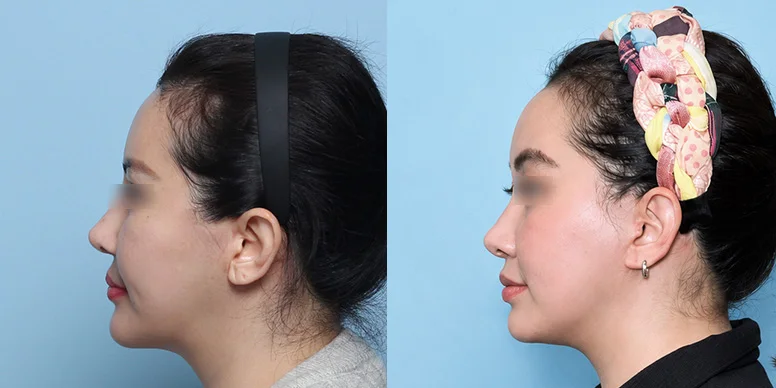 Before & After Before & After