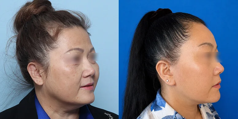 Before & After Before & After