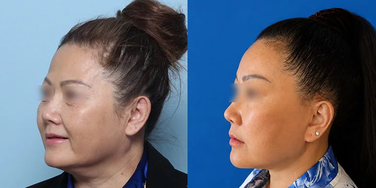 Before & After Before & After