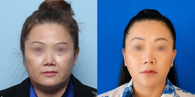 Lifting Before & After — Before & After