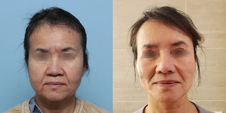 Lifting Before & After — Before & After
