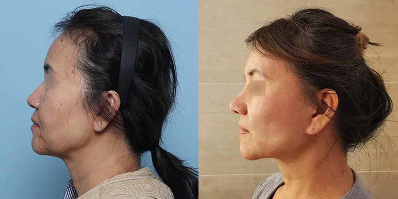 Before & After Before & After