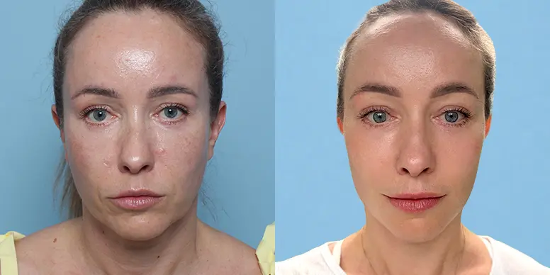 Lifting Before & After — Before & After