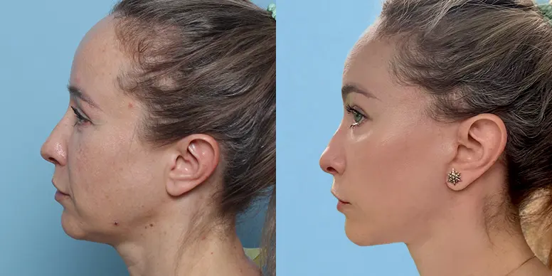 Before & After Before & After