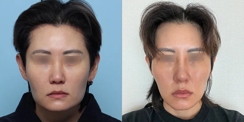 Nose Before & After — Before & After