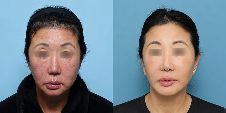 Lifting Before & After — Before & After