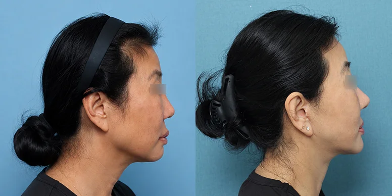 Before & After Before & After