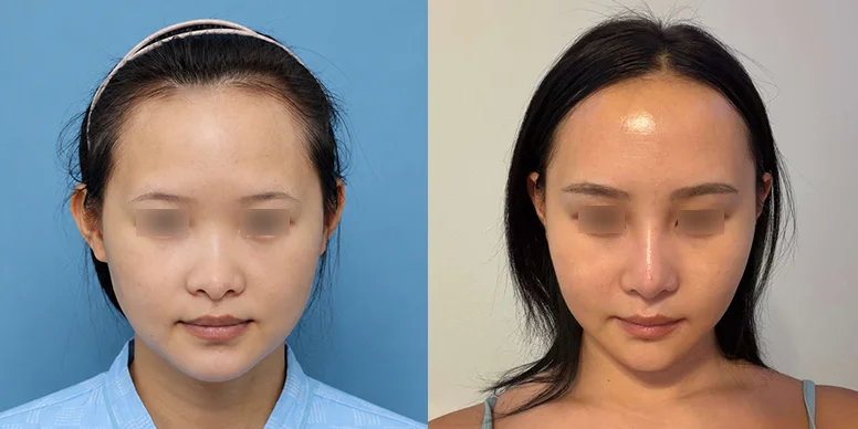 Nose Before & After — Before & After