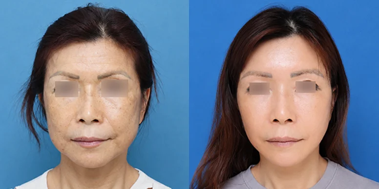 Mata Sebelum & Sesudah — Sebelum & Sesudah