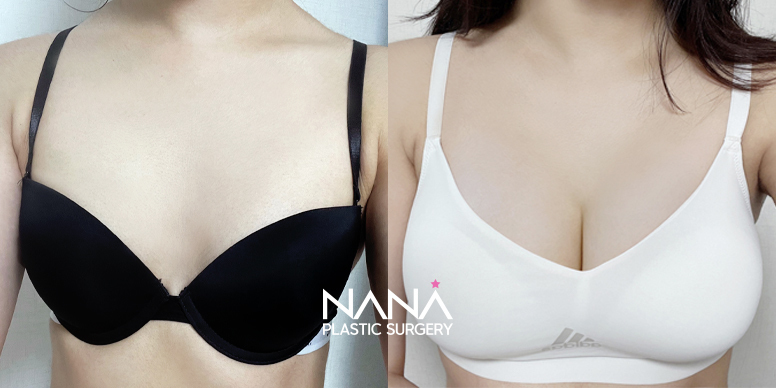 Breast Before & After — Before & After
