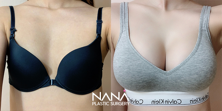 Breast Before & After — Before & After