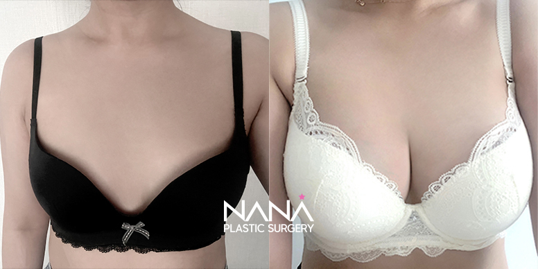 Breast Before & After — Before & After