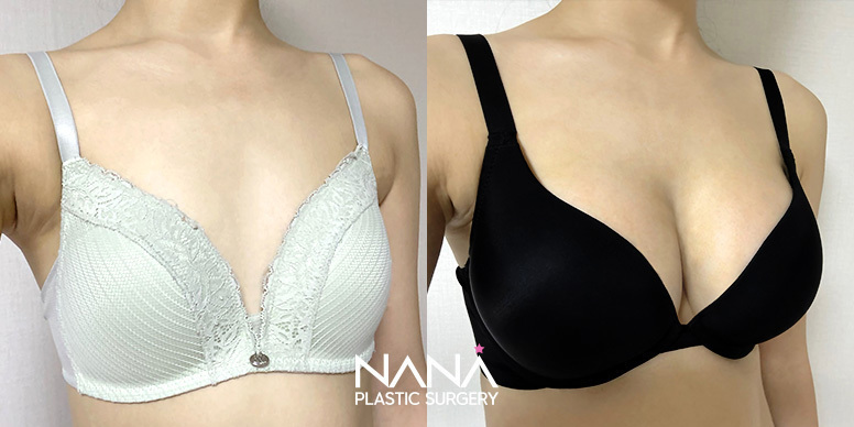 Breast Before & After — Before & After