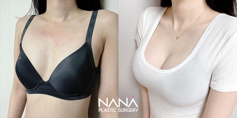 Breast Before & After — Before & After
