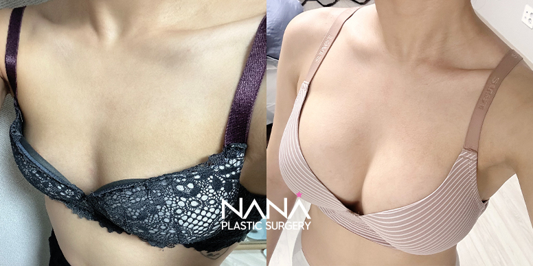 Breast Before & After — Before & After