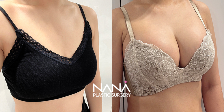 Breast Before & After — Before & After
