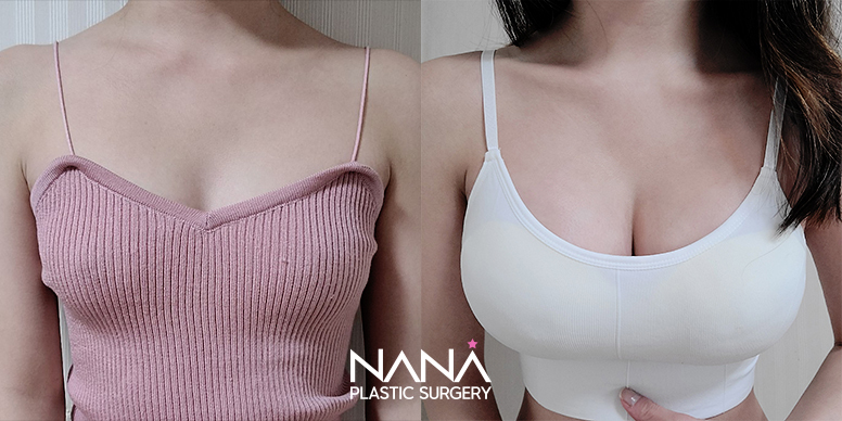 Breast Before & After — Before & After