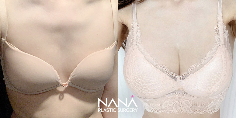 Breast Before & After — Before & After