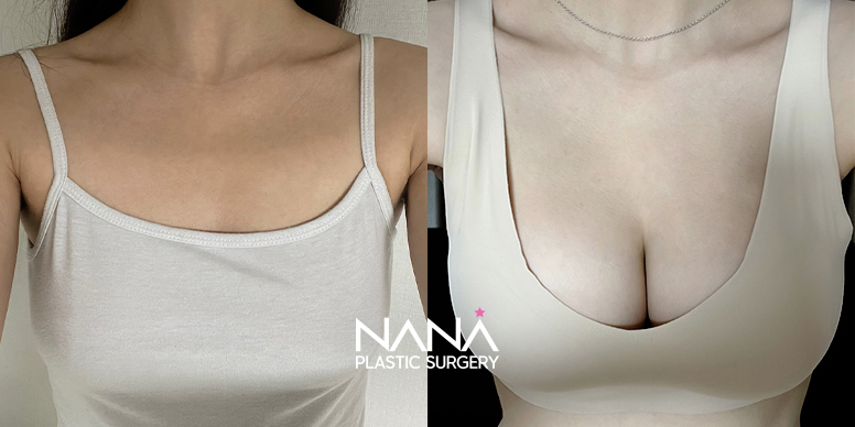 Breast Before & After — Before & After