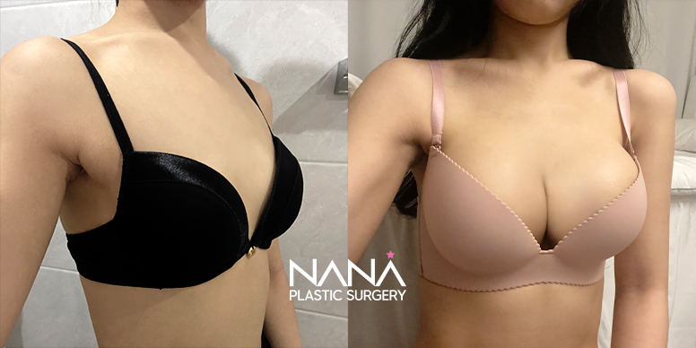 Breast Before & After — Before & After