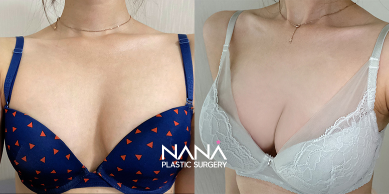Breast Before & After — Before & After