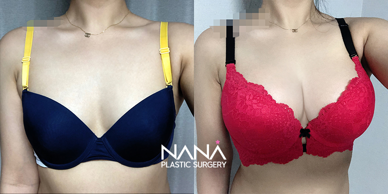 Breast Before & After — Before & After