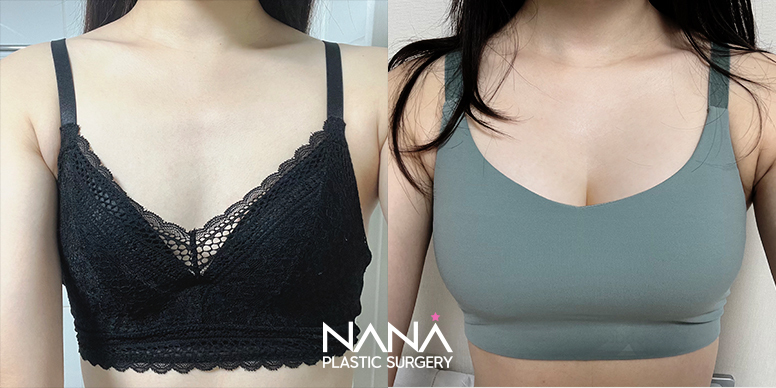Breast Before & After — Before & After