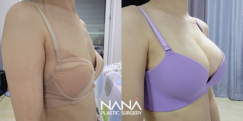 Breast Before & After — Before & After