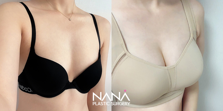 Breast Before & After — Before & After
