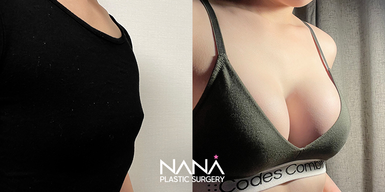 Breast Before & After — Before & After