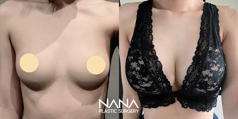 Breast Before & After — Before & After