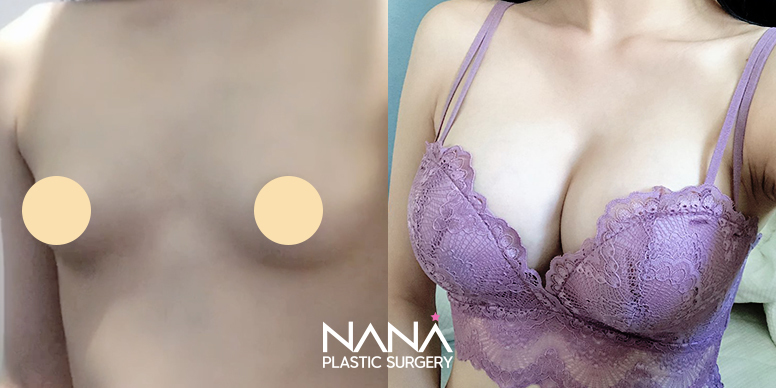 Breast Before & After — Before & After