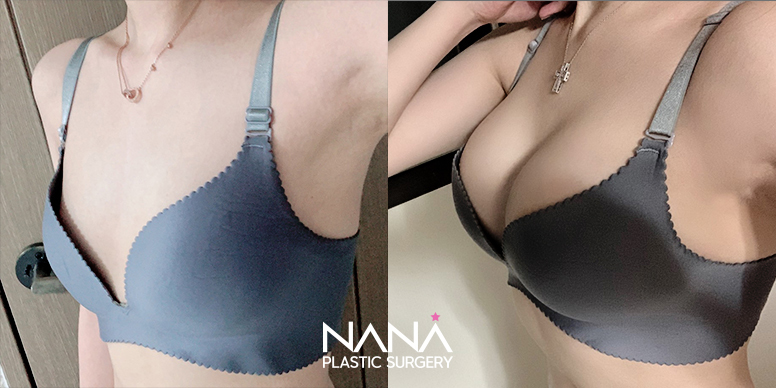 Breast Before & After — Before & After