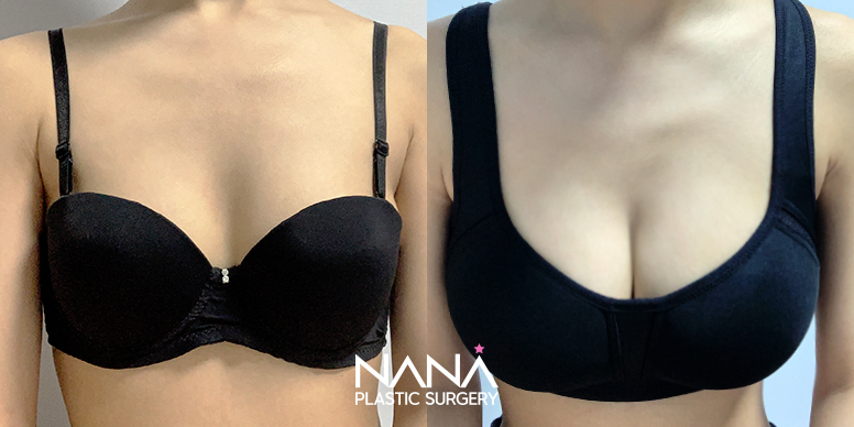 Breast Before & After — Before & After
