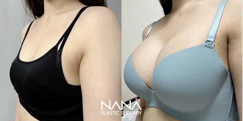 Breast Before & After — Before & After